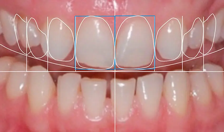 Dental Veneers: A Perfect Smile