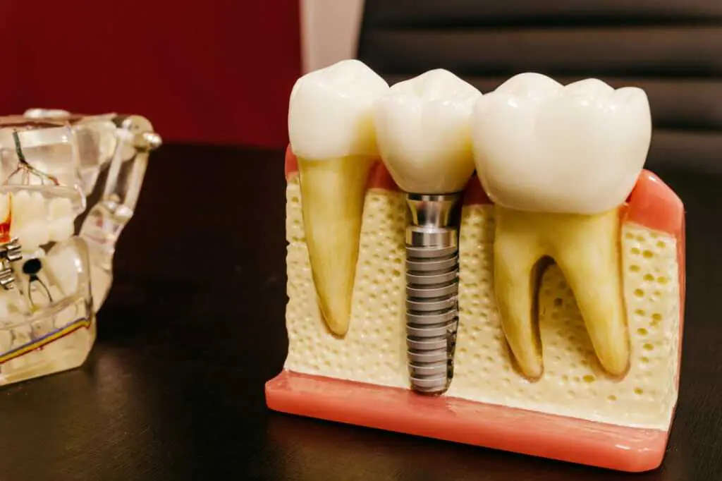 Implantes dentales en Quito