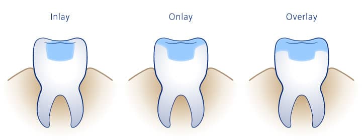 restauraciones dentales en quito