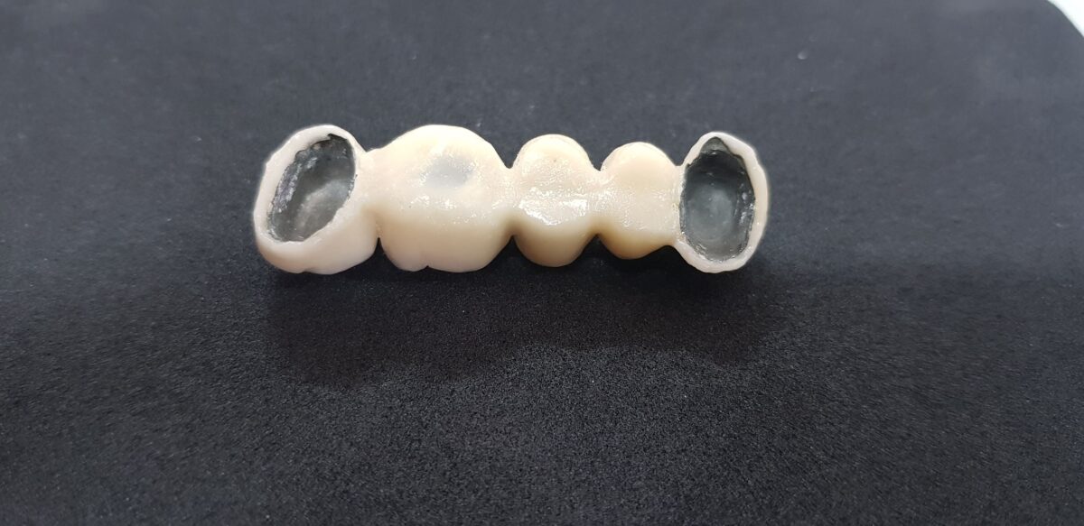 Prótesis dental fija en metal y cerámica