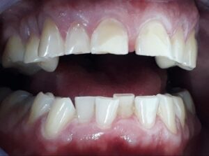 tipos de dientes chuecos: Diastema entre incisivos centrales superiores