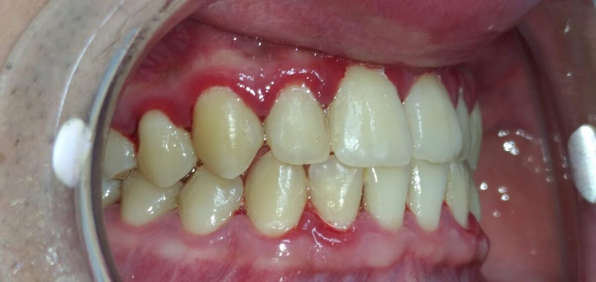 gingivitis early stages