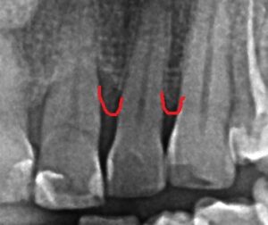 bone loss due to periodontal disease