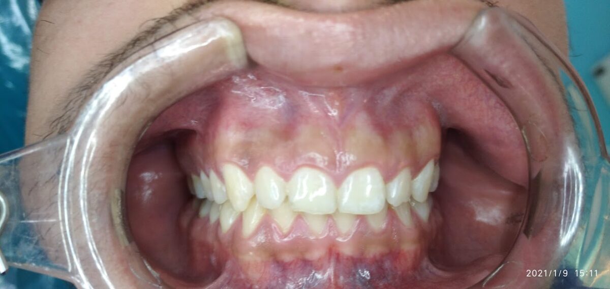 gingivectomía: antes