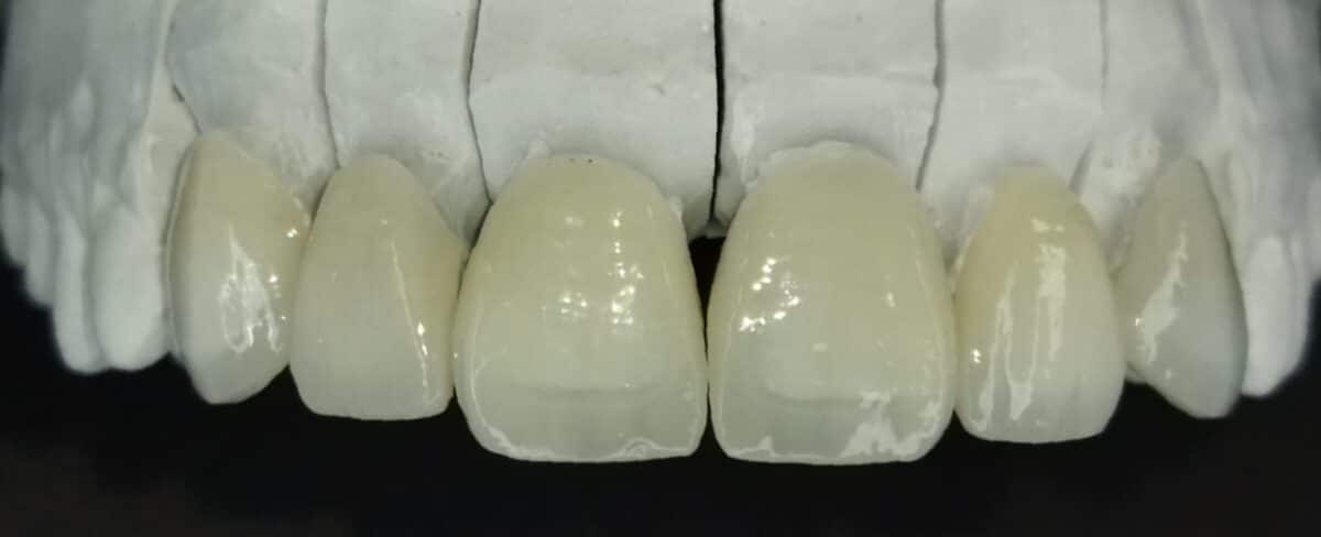 carillas dentales de porcelana instaladas en modelo de yeso