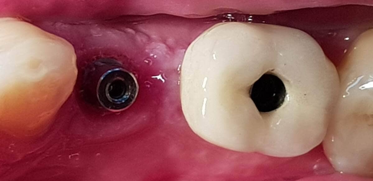 coronas soportadas sobre implantes en proceso de instalación.