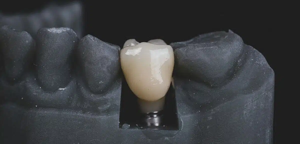 Coronas sobre Implantes Dentales