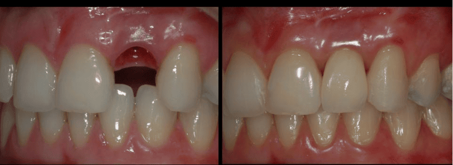 Recuperación de diente anterior con puente adhesivo maryland