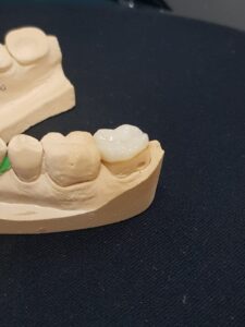 endocorona realizada en Centro Odontológico Asiri en Quito