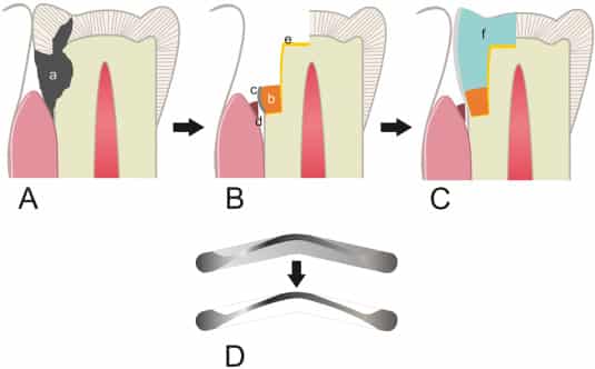 Pasos para realizar una elevación de margen profundo