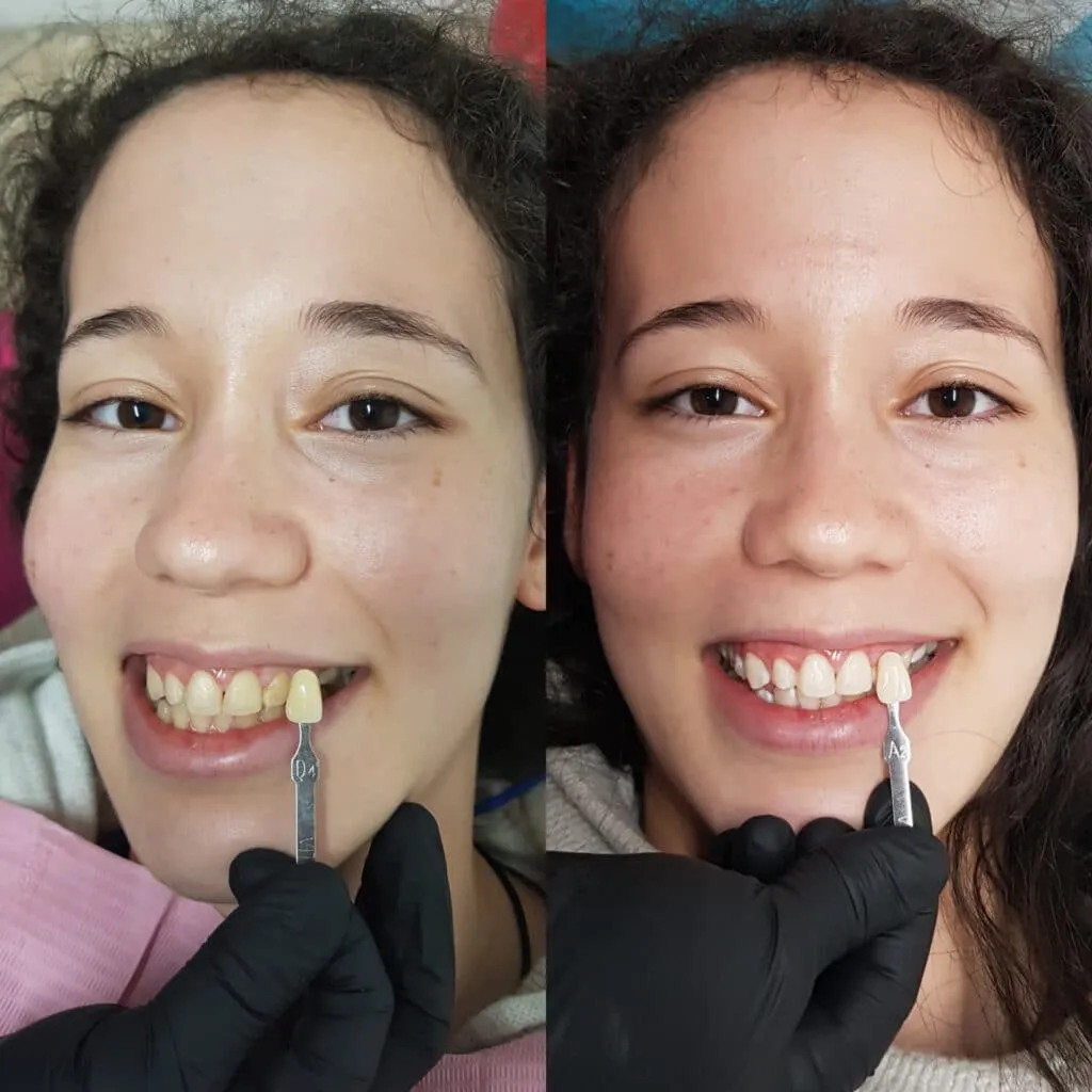 Blanqueamiento Dental