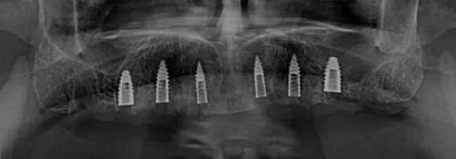 implantes para prótesis total atornillada