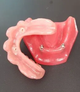 sobredentadura sobre dos implantes