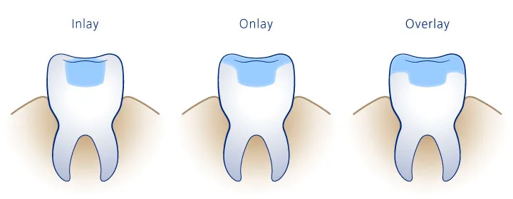 restauraciones dentales en quito