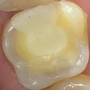 base de incrustación dental