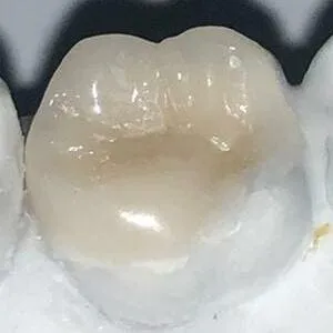 onlay sobre modelo de yeso