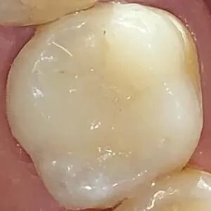 incrustación dental instalada