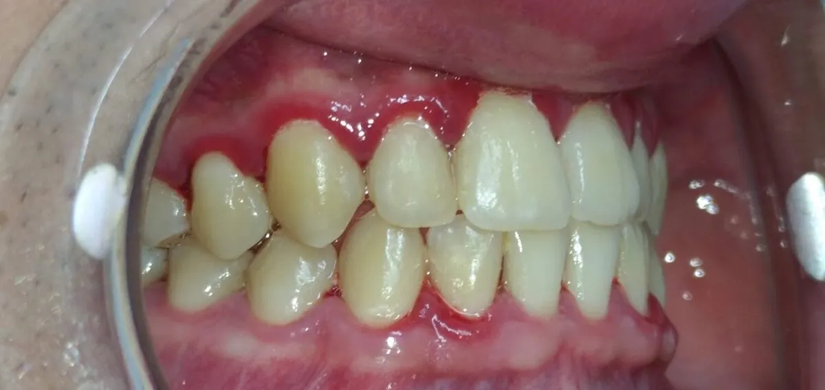 Gingivitis