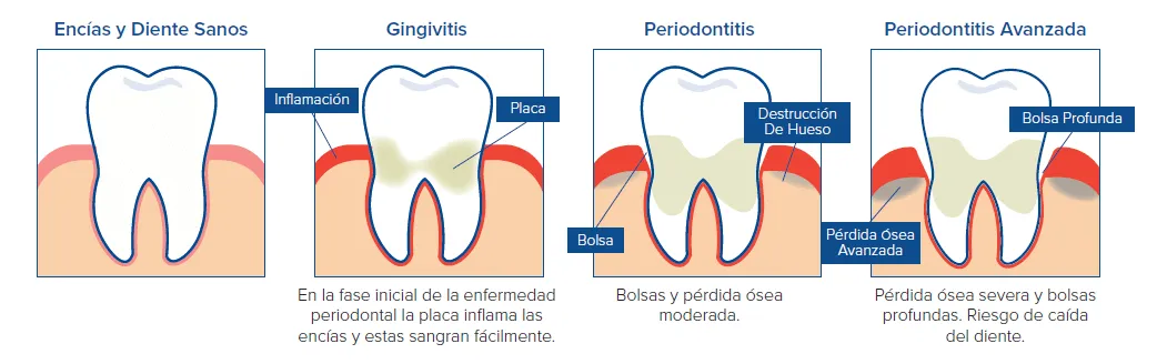 periodontal disease evolution
