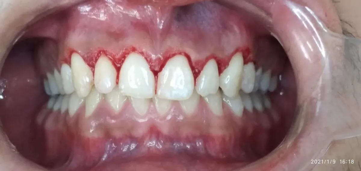 Foto: Archivo Asiri gingivectomy just finished