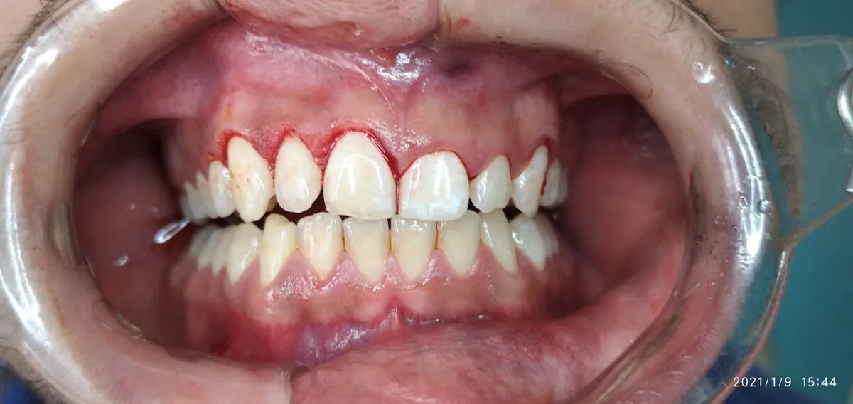 Foto: Archivo Asiri during gingivectomy