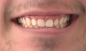 gummy smile before gingivectomy