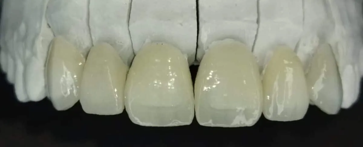 Porcelain Dental Veneers in Quito, Ecuador