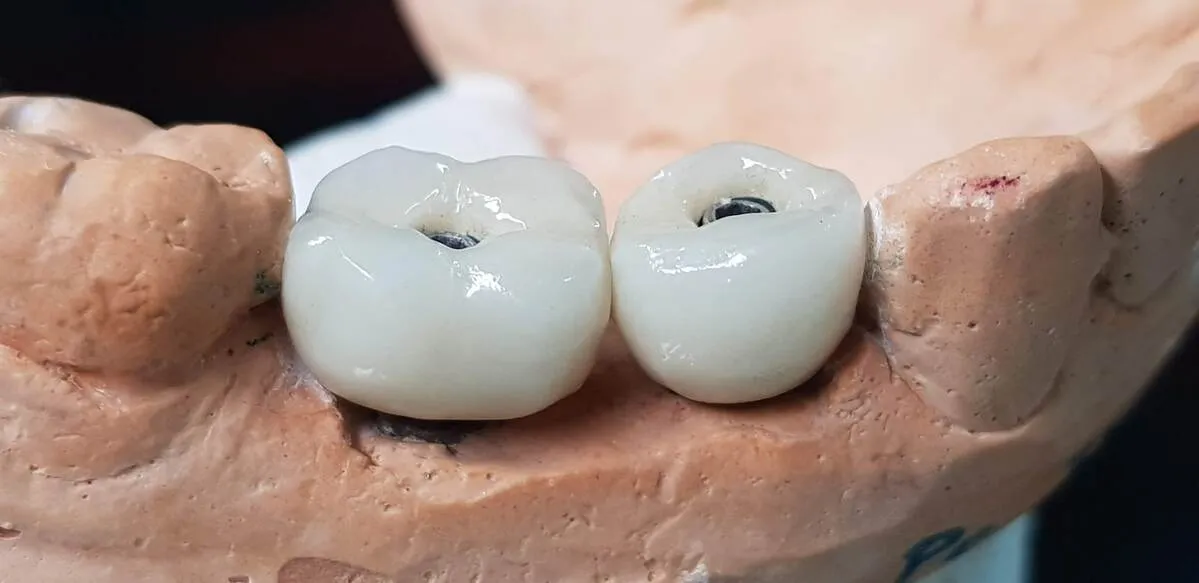Modelo con Coronas de Zirconio sobre implantes