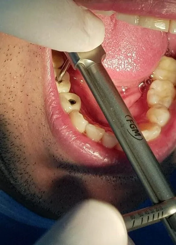 Atornillado de Corona sobre implante en quito