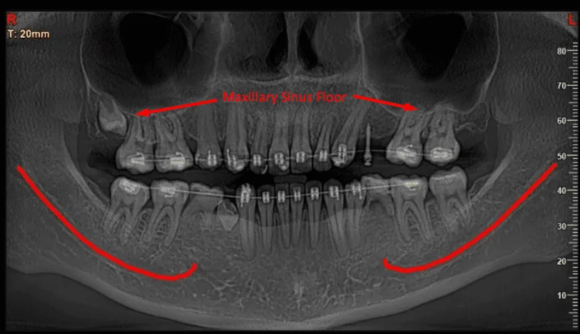 maxillary sinus floor